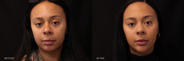 A photos of a woman's face before and after Chin & Lips Filler procedure. Before photo shows a shrinked jawbone caused by her collapse tent pole while after photo shows a re-shaped chin and tightened skin.| Albany, Latham, Saratoga NY, MedSpa