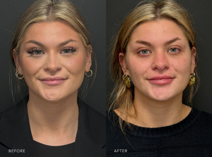 A photo of a woman's face before and after the Botox procedure. Before photo shows fine lines or creases that are horizontally oriented or radiated outward from the inner corners of her eyes. The after photo shows smoother and softer skin beneath her lower eyelids, with a reduction of visible lines. | Albany, Latham, Saratoga NY, Plastic Surgery