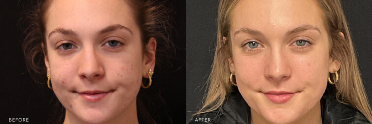 A photo of a woman's face before and after Micronneeding procedure. Before photo shows pus-filled lessions on her skin's surface, leading to a darkened appearance. While the after photo shows improvement in the overall complexion with a reduction of visible pimples, making her skin look clearer and smoother. | Albany, Latham, Saratoga NY, MedSpa