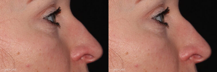 This is a side by side by side view photos before and after Liquid Rhinoplasty. Before photo shows her dorsal hump in her nose while after photo shows her straightened nose bridge. | Albany, Latham, Saratoga NY, MedSpa