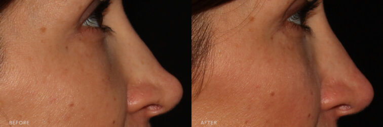 This is a side by side view photos of a woman's face before and after Functional Rhinoplasty procedure. Before photo shows her misaligned septum while after photo shows a repositioned cartilage that is vertically alligned. | Albany, Latham, Saratoga NY, MedSpa