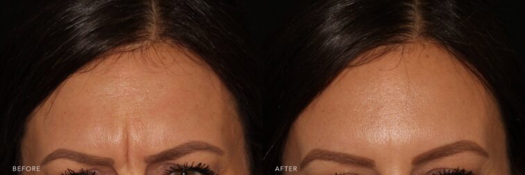 A photo of a woman's face before and after the Botox procedure. The before photo shows a less smooth skin surface, with a slightly uneven texture, catching and scattering light in a way that highlights fine lines and creases. The after photo shows a smoother, more refined skin surface that reflects light evenly, creating a radiant, youthful glow without the distraction of fine lines or texture irregularities. | Albany, Latham, Saratoga NY, Plastic Surgery