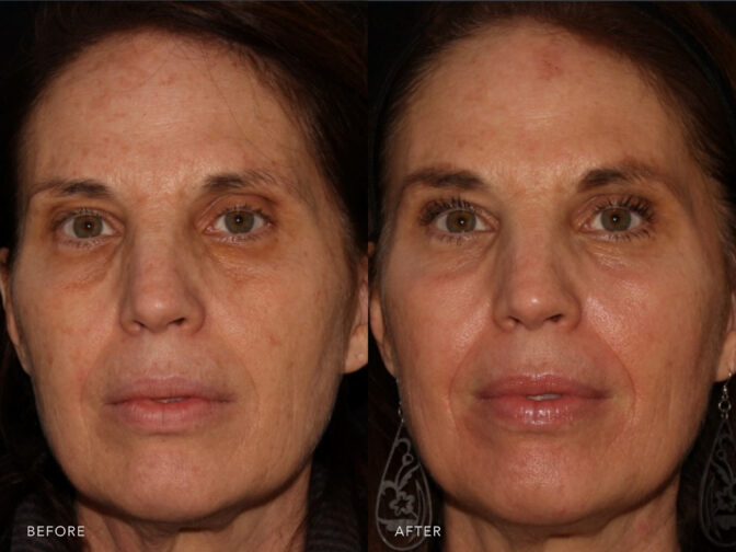 A photo of a woman's face before and after the Chemical Peel procedure. Before photo shows a decrease in collagen and elastin due to the natural aging process, causing wrinkles to form and deepen. The after photo shows relaxed facial muscles that plump up her skin and reduce the depth of deep wrinkles. | Albany, Latham, Saratoga NY, Plastic Surgery