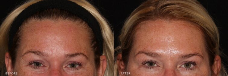 A photo of a woman's face before and after the Botox procedure. The before photo shows visible horizontal lines and some fine wrinkles around her eyes, with the skin texture slightly uneven with visible expression lines. The after photo shows a reduction in horizontal lines and fine wrinkles, with her skin looking tighter and a subtle lift around the brows and eyelid area. | Albany, Latham, Saratoga NY, Plastic Surgery