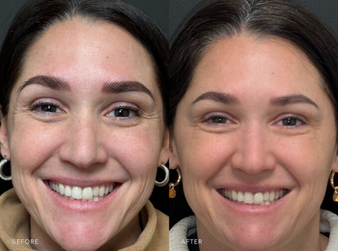 A photo of a woman's face before and after the Botox procedure. Before photo shows subtle lines and barely noticeable, appearing as thin on her skin's surface. The after photo shows a younger appearance with fewer visible lines, creating a smoother and more youthful complexion. | Albany, Latham, Saratoga NY, Plastic Surgery