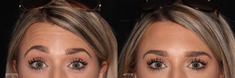 A photo of a woman's face before and after the Botox procedure. The before photo shows noticeable horizontal lines across her forehead, caused by the frontalis muscle contracting when her brows are raised. The after photo shows a smooth, line-free forehead with relaxed frontalis muscles, creating a calm, youthful appearance even when the brows are raised. | Albany, Latham, Saratoga NY, Plastic Surgery