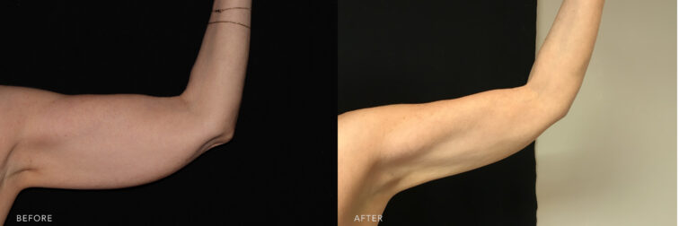 A side-by-side photo of a woman's left arm before and after the Coolsculpting procedure. Before photo shows a bat wing appearance where excess fat is hanging down when her arms are extended or moved, while the after photo shows a tightly toned arm and toned-up muscles resulting in a youthful appearance of her arms. | Albany, Latham, Saratoga NY, MedSpa