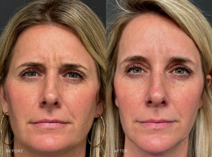 A photo of a woman's face before and after the Botox procedure. Before photo shows a hollowed appearance and a more pronounced tear trough due to the volume loss of her skin. The after photo shows minimal or subtle signs of aging around her eyes, conveying a sense of retained youthfulness. | Albany, Latham, Saratoga NY, Plastic Surgery 