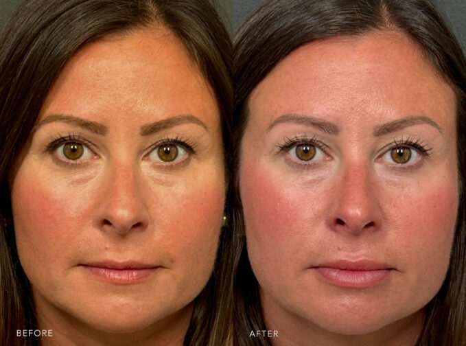 A photo of a woman's face before and after the Botox procedure. Before photo shows visible vertical lines on her upper lip, especially when speaking or puckering, caused by repetitive muscle movement.The after photo shows a fuller and more pronounced upper lip when at rest and smiling, making her lips more visible without adding volume. | Albany, Latham, Saratoga NY, Plastic Surgery