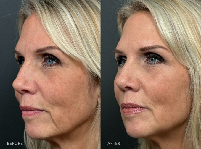 A side-by-side of a woman's face before and after the Filler Treatment. Before photo shows a little distinction between her neck and jawline, causing the two areas to merge without clear definition, creating the appearance of a thicker neck or less separation between facial and neck contours. The after photo shows a more defined and angular jaw, giving her lower face a stronger and more contoured look. | Albany, Latham, Saratoga NY, Plastic Surgery