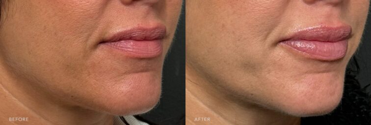 A side-by-side view of a woman's lower face before and after the Lip Filler procedure. The before photo shows a less defined or softer cupid's bow, making the curve less noticeable and a narrower appearance. The after photo shows a more defined cupid's bow, creating a sculpted, heart-shaped appearance and making her lips look naturally fuller. | Albany, Latham, Saratoga NY, Plastic Surgery