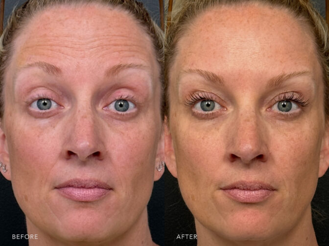 A photo of a woman's face before and after the Botox procedure. Before photo shows horizontal lines that run across the width of her forehead with visible changes in texture due to the presence of wrinkles. The after photo shows improved skin elasticity and firmness, allowing her skin to bounce back easily when touched or moved. | Albany, Latham, Saratoga NY, Plastic Surgery
