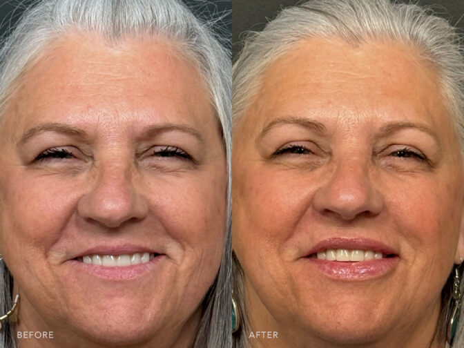 A photo of a woman's face before and after the Lip Filler procedure. Before photo shows the natural border of her lips became less defined and more blurred, especially the line separating her lip from the surrounding skin. The after photo shows a fuller lip with rich, vibrant color and naturally rosy red, which adds to their visual appeal. | Albany, Latham, Saratoga NY, Plastic Surgery