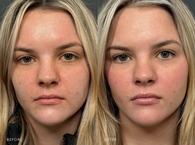 A photo of a woman's face before and after the Lip Filler procedure. Before photo shows a naturally thin lip, lacking fullness or volume, creating a less prominent or defined lip shape. The after photo shows a plumber and more voluminous lips, giving a more youthful and distinguished look to her face. | Albany, Latham, Saratoga NY, Plastic Surgery