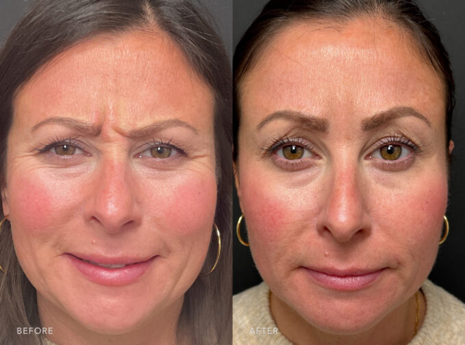 A photo of a woman's face before and after the Botox procedure. Before photo shows wrinkles around her eyes that contribute to an aged or tired appearance, affecting her overall facial aesthetics and expression. The after photo shows diminished fine lines or wrinkles that were previously present around her eyes are noticeably reduced or less prominent. | Albany, Latham, Saratoga NY, Plastic Surgery