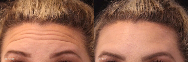 A photos of a woman's upper face before and after Botox procedure. Before photo shows evident fine lines in her forehead while after photo shows a reduced fine lines that helped to plump up the skin's appearance.| Albany, Latham, Saratoga NY, MedSpa