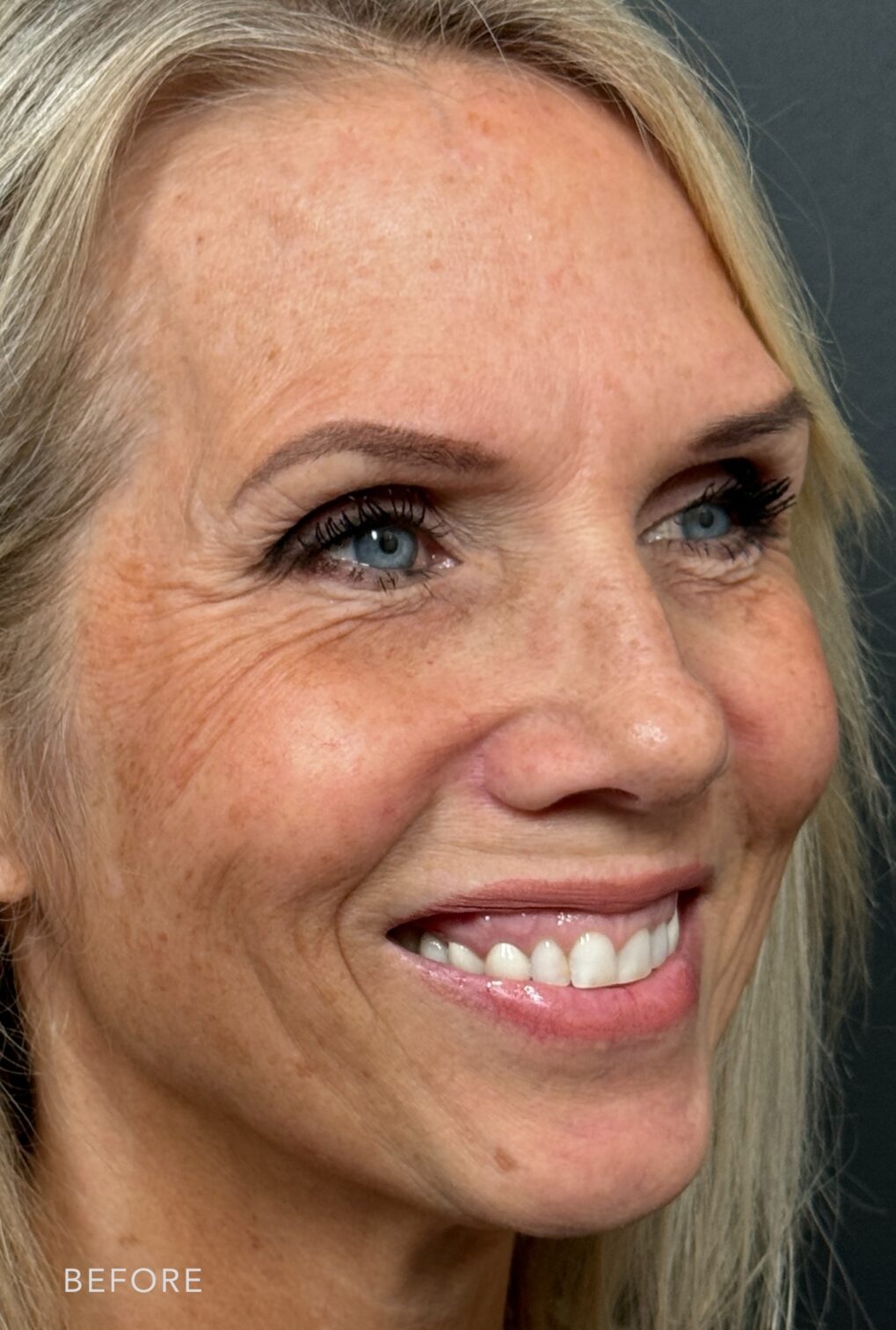 A side-by-side of a woman's face before and after the Filler Treatment. Before photo shows a little distinction between her neck and jawline, causing the two areas to merge without clear definition, creating the appearance of a thicker neck or less separation between facial and neck contours. The after photo shows a more defined and angular jaw, giving her lower face a stronger and more contoured look. | Albany, Latham, Saratoga NY, Plastic Surgery