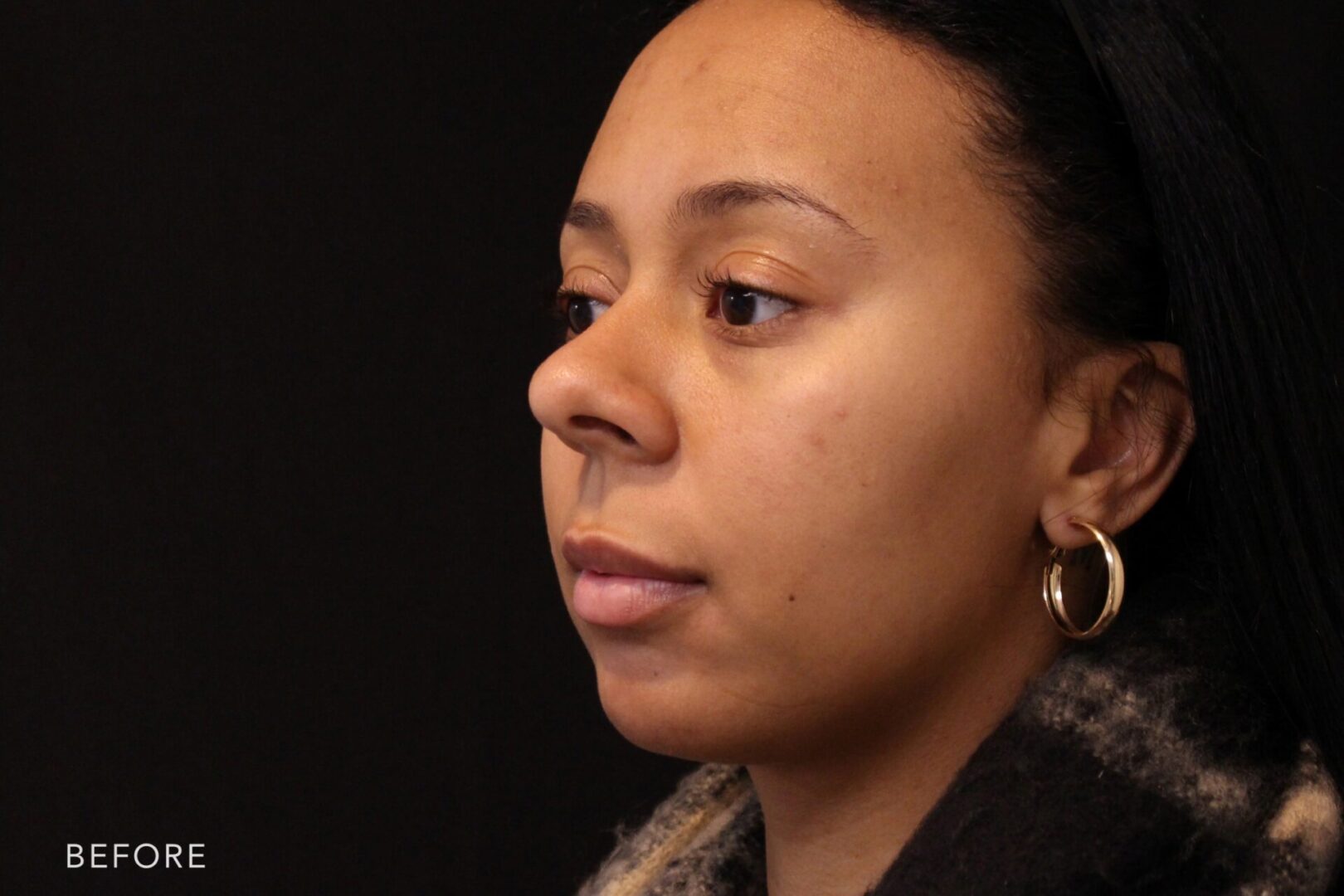 A photos of a woman's face before and after Chin & Lips Filler procedure. Before photo shows a shrinked jawbone caused by her collapse tent pole while after photo shows a re-shaped chin and tightened skin.| Albany, Latham, Saratoga NY, MedSpa