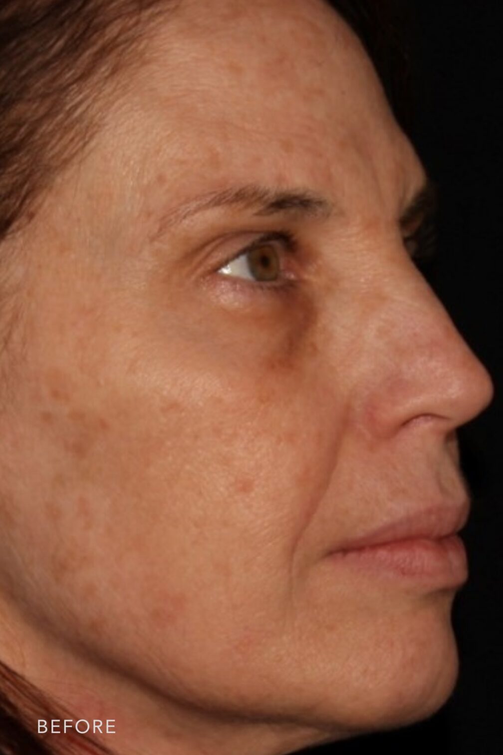 A photo of a woman's face before and after the Chemical Peel procedure. Before photo shows a decrease in collagen and elastin due to the natural aging process, causing wrinkles to form and deepen. The after photo shows relaxed facial muscles that plump up her skin and reduce the depth of deep wrinkles. | Albany, Latham, Saratoga NY, Plastic Surgery