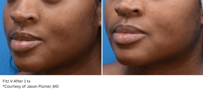 moxi laser treatment before and after