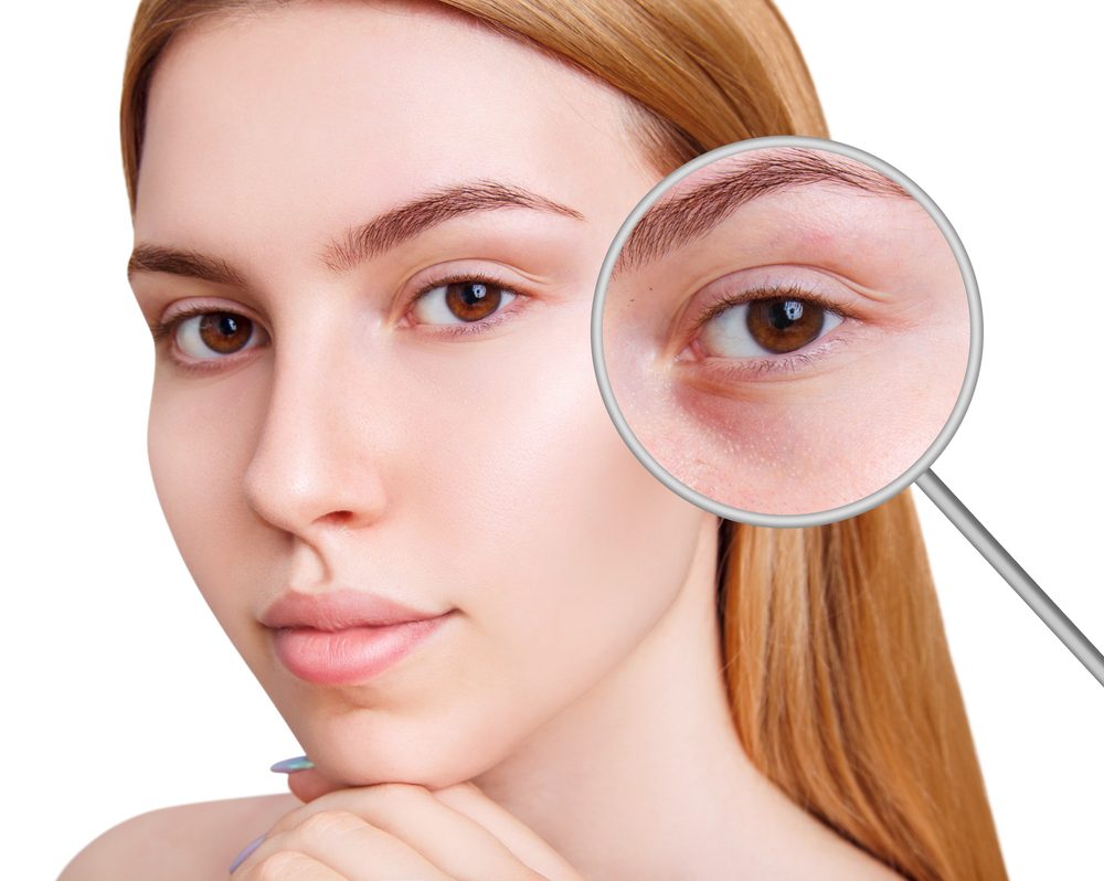 Under-Eye Filler Treatments in Northern Saratoga County